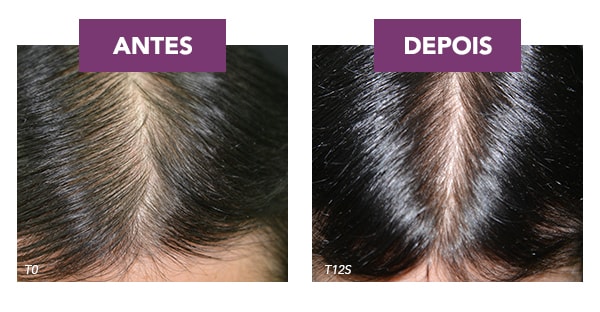 2,5X MENOS* QUEDA DE CABELO